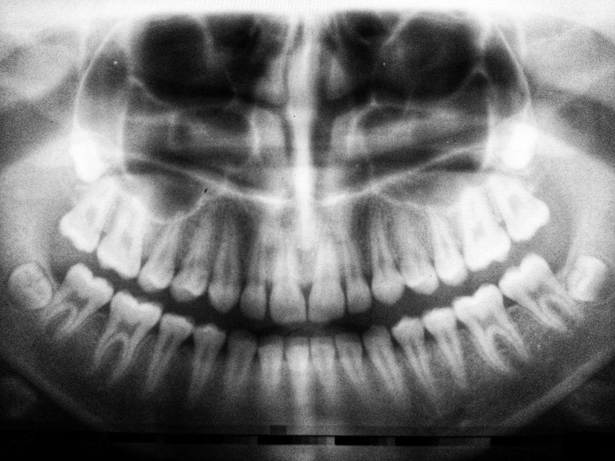 A panoramic dental X-ray showing wisdom teeth position