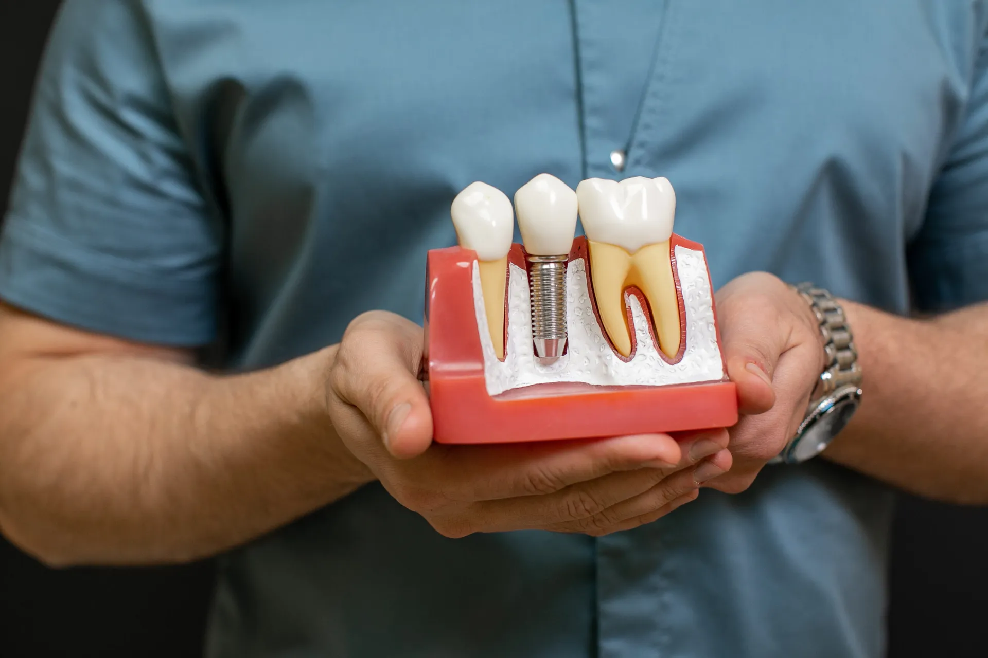 Closeup Male Dentist Doctor Hands With Dental Implant Model As Teaching Aid 1 at Magical Smiles Caroline Springs
