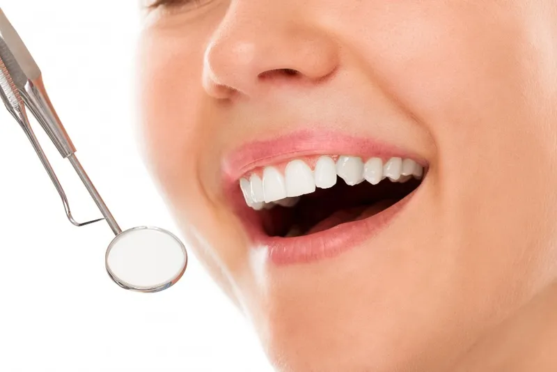 What Are Dental Veneers 1 at Magical Smiles Caroline Springs