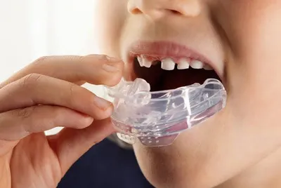 A Myobrace appliance, the soft removable device worn during quiet time and overnight as part of the Myobrace System.