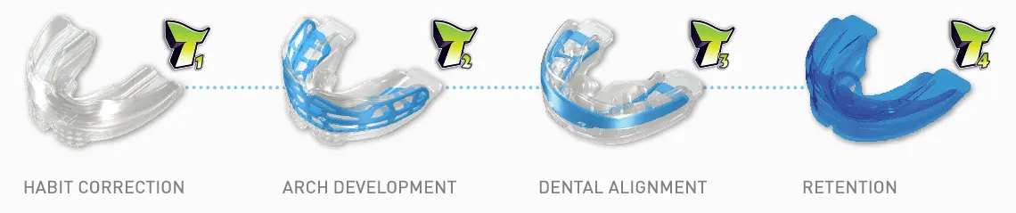 The Myobrace four-stage appliance sequence: habit correction, arch development, dental alignment, and retention.
