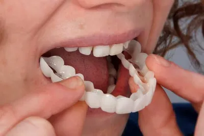 A close-up of a Snap-On Smile appliance being fitted by hand over the lower teeth