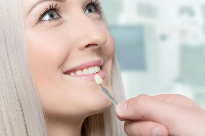A dentist holding a shade tab against a patient's smile to match the resin colour