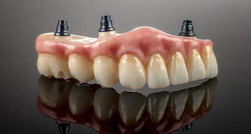 An implant-supported overdenture that clips securely onto implants