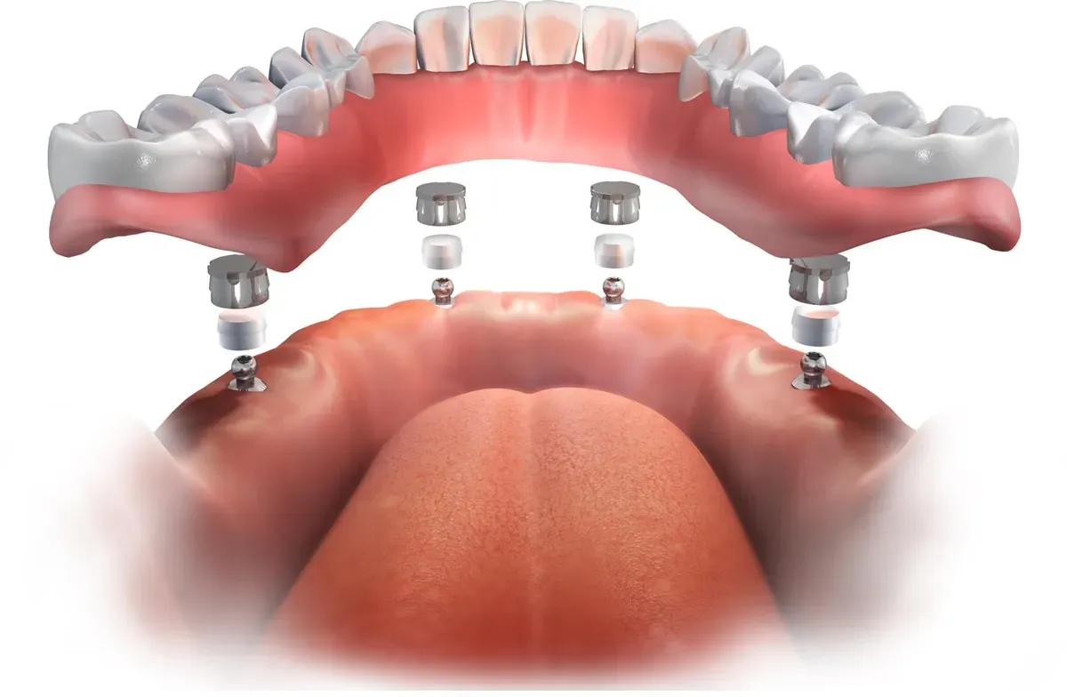 A full-arch implant-supported denture model