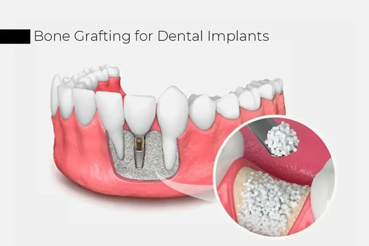 Bone grafting treatment used to build bone volume before an implant is placed