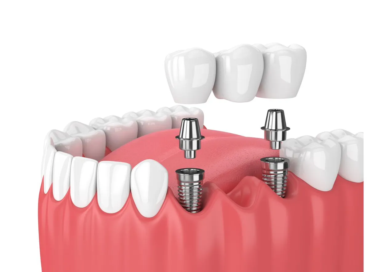 A model showing an implant-supported bridge spanning several missing teeth