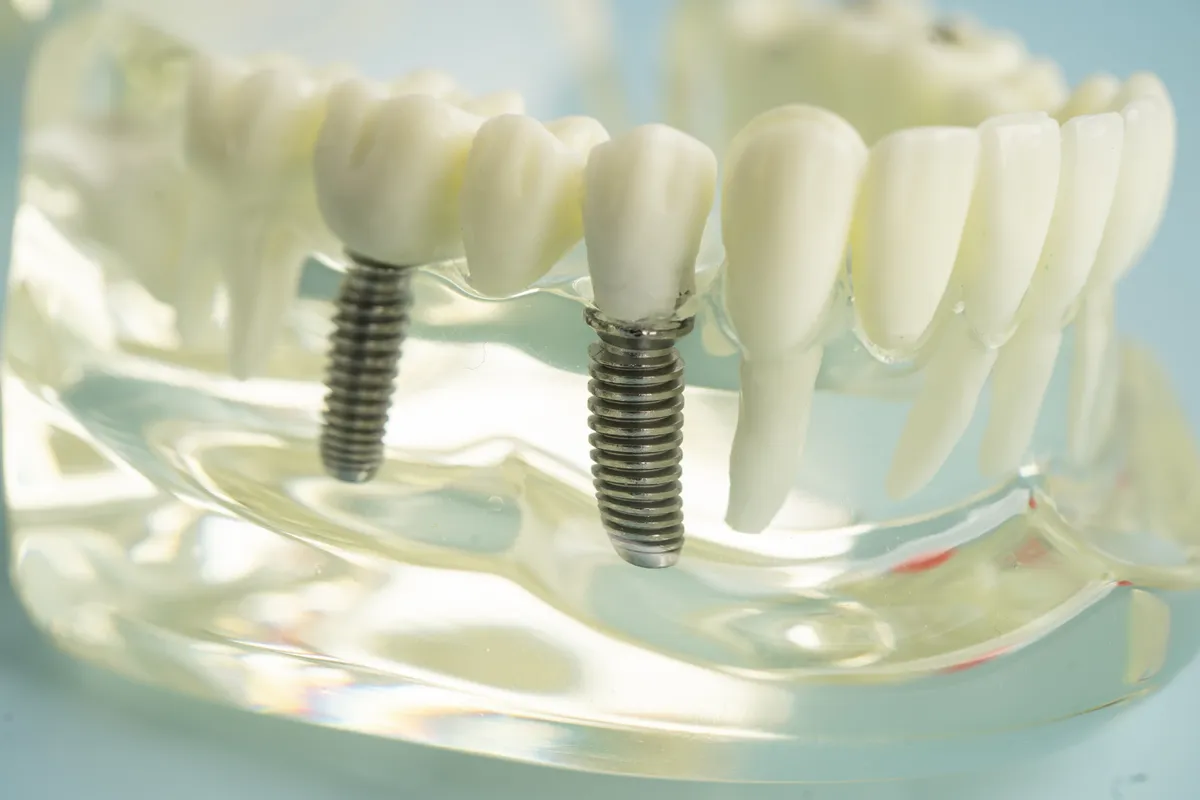 A model showing an implant-supported bridge replacing several adjacent teeth