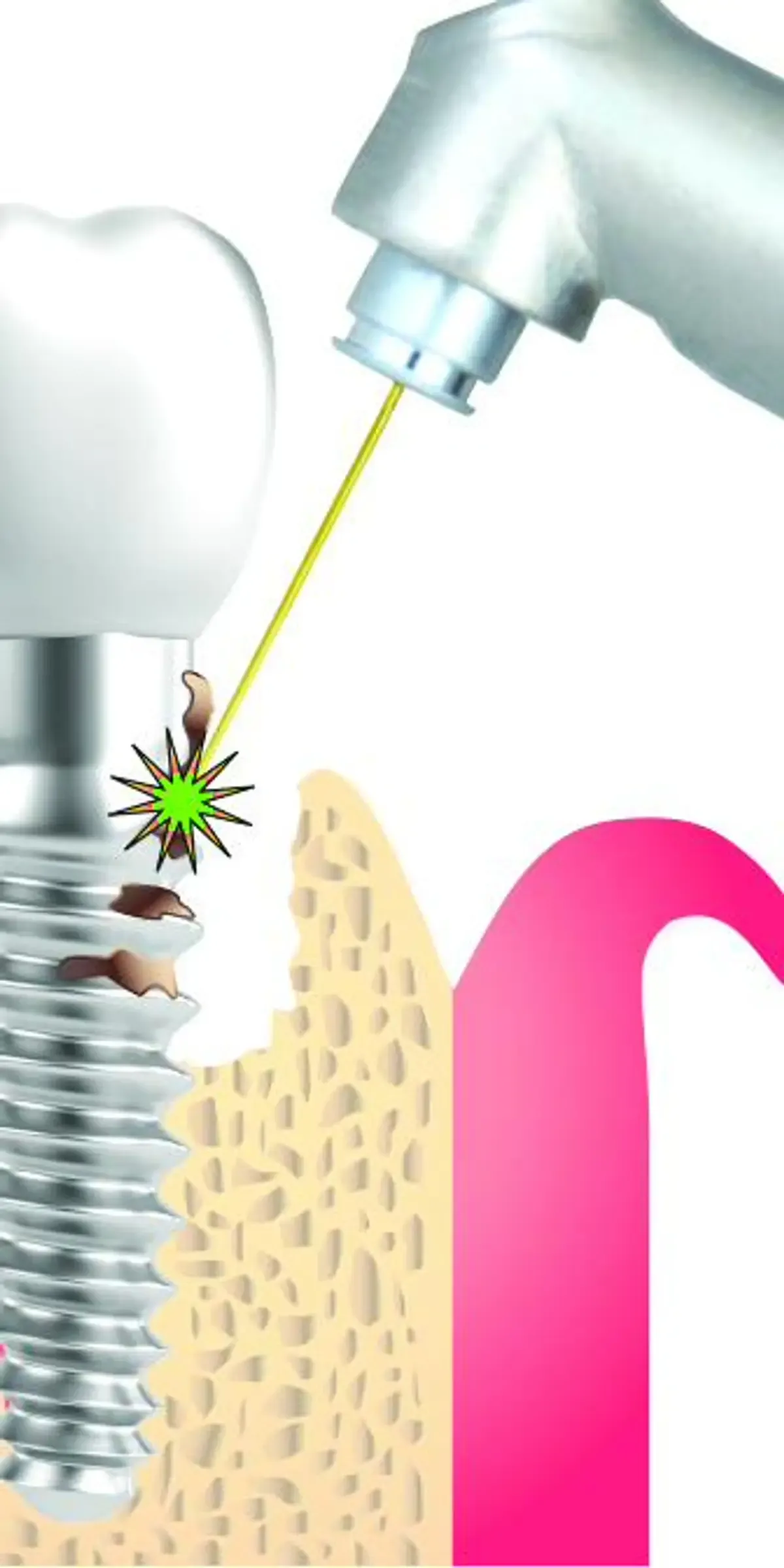 Clinical illustration of gum tissue around a dental implant