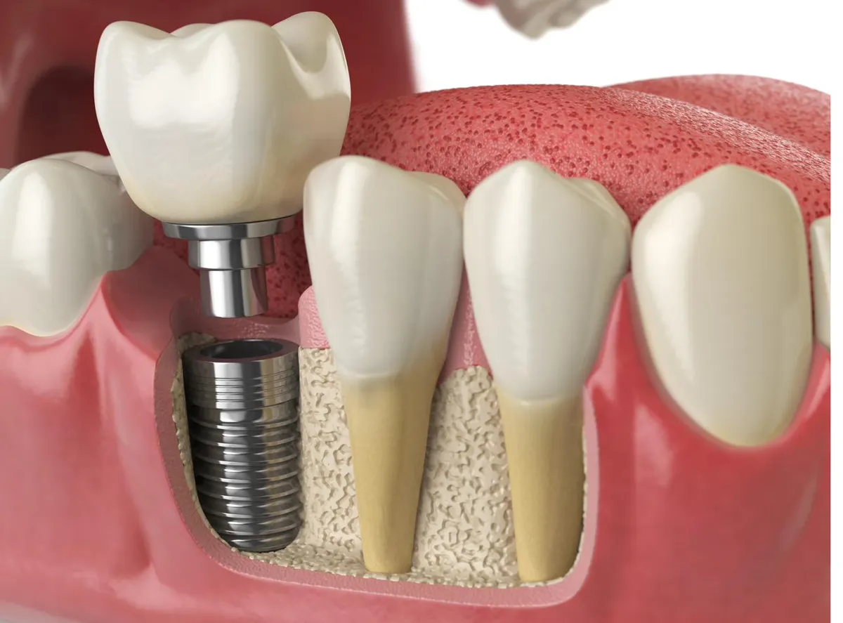 A model showing a single dental implant post placed in the jawbone