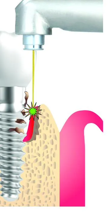 Clinical illustration of gum tissue around a dental implant