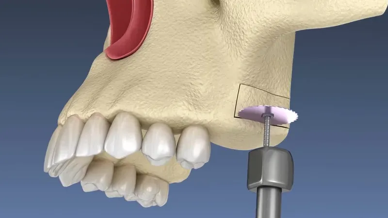 3D render showing a sinus lift procedure with lateral access in the upper jaw