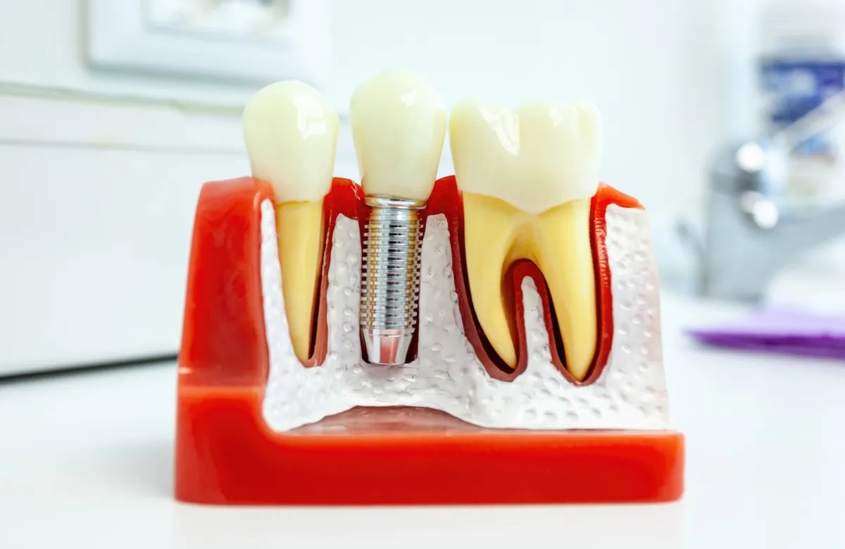 A single dental implant post and crown model