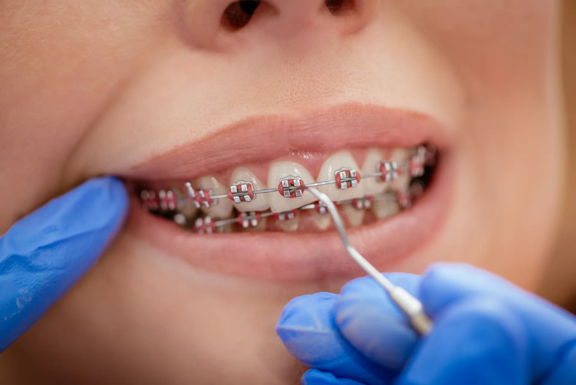 A close-up of teeth with braces during a dental cleaning appointment