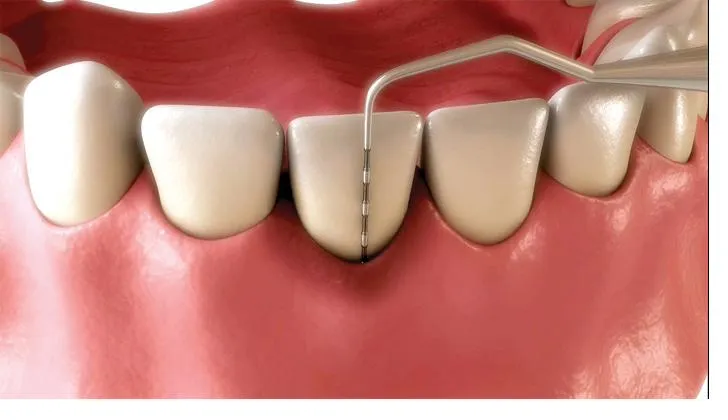 Clinical illustration of a periodontal probe gently measuring gum pocket depth — the routine screening that begins every scale and clean appointment at Magical Smiles Caroline Springs