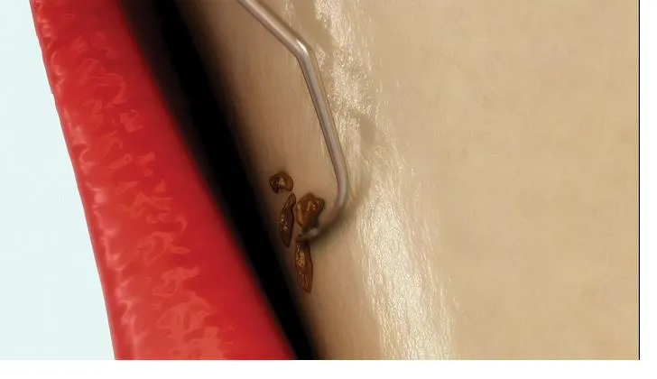 Clinical illustration showing scaling of the tooth root surface — the core action of a deep clean (scaling and root planing) procedure