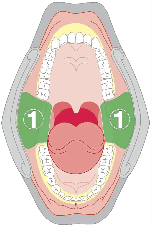Anatomical diagram of an oral cavity from above, with the tonsillar pillars on either side highlighted as zone one.