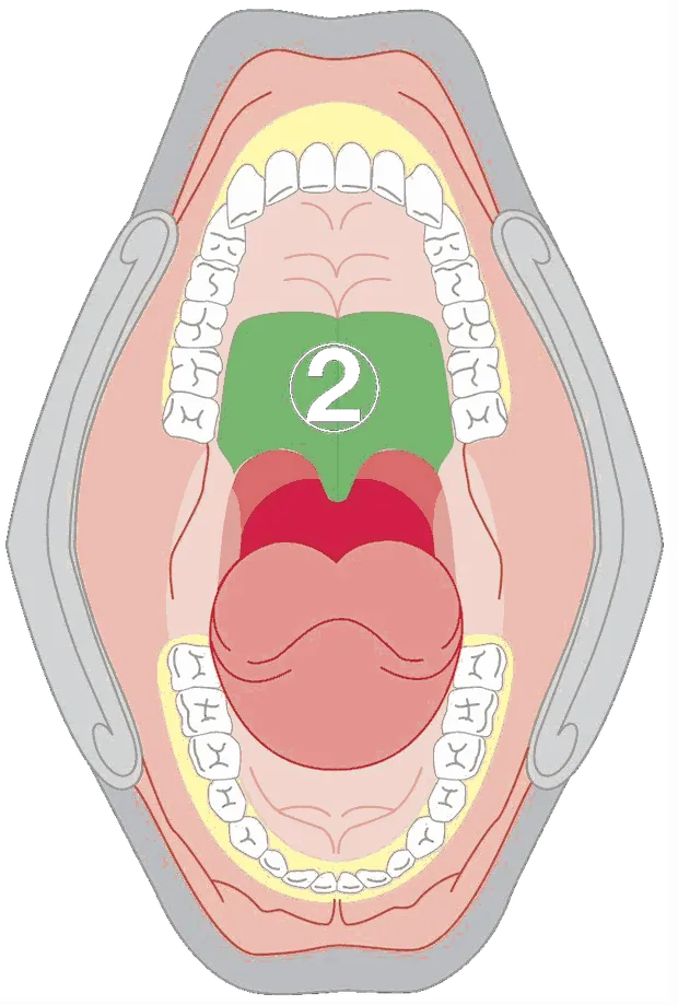Anatomical diagram of an oral cavity from above, with the soft palate highlighted as zone two.
