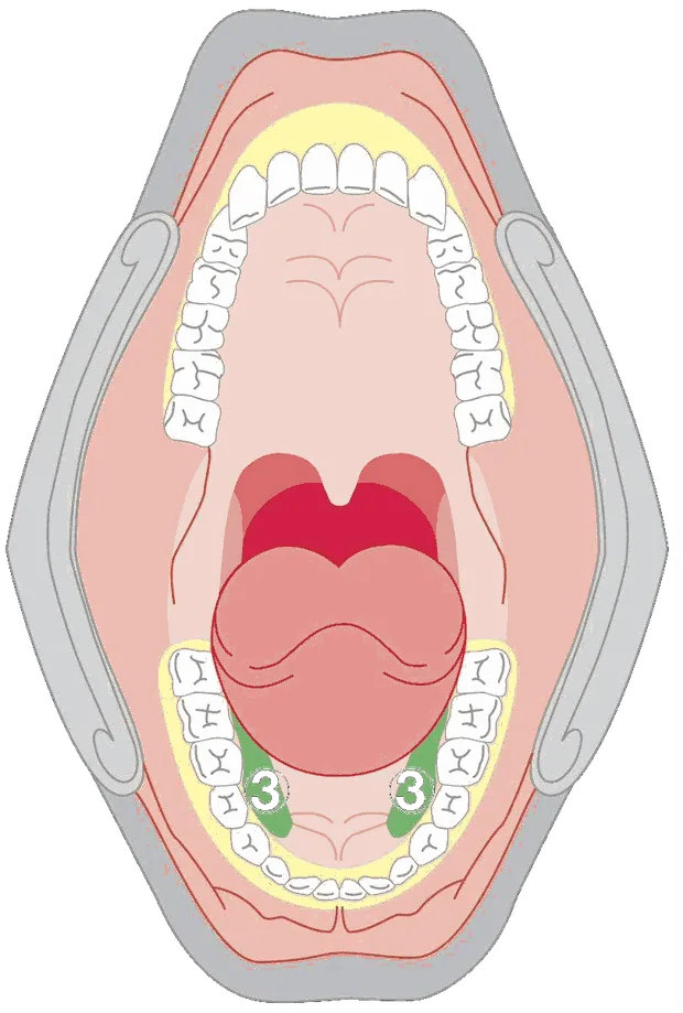Anatomical diagram of an oral cavity from above, with the base of the tongue highlighted as zone three.