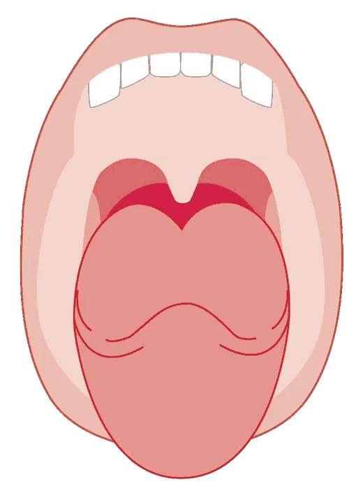 Diagram of an open mouth with a less pronounced tonsillar area, suggesting lighter snoring.