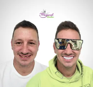 Smile transformation, before and after