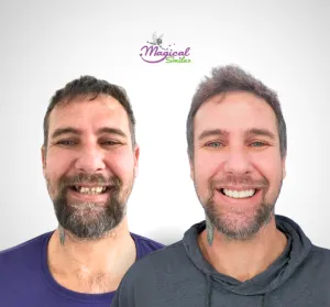 Smile transformation, before and after
