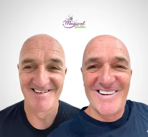 Smile design, before and after