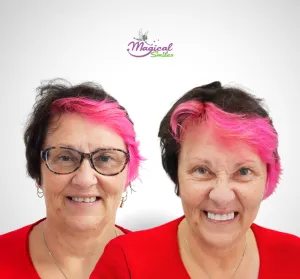 Smile design, before and after