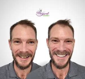 Smile transformation, before and after