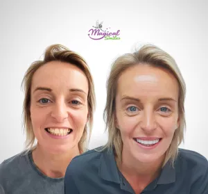 Cosmetic dentistry, before and after