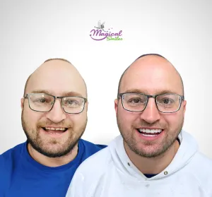 Veneers, before and after