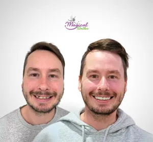 Crowns, before and after