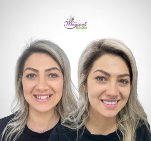 Smile makeover, before and after