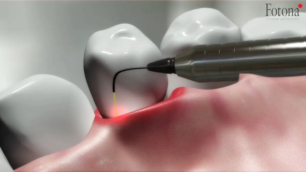 TwinLight® Laser-Assisted Periodontal Therapy — watch on YouTube