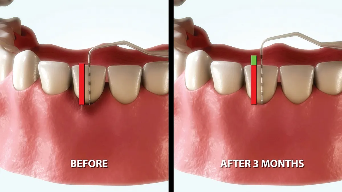 Periodontal pocket depth — before LAPT treatment vs after 3 months. Clinical illustration.