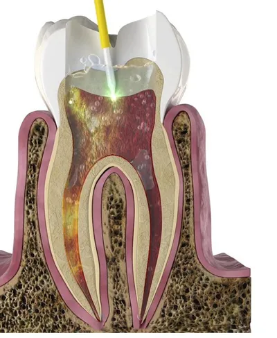 Clinical illustration of laser endodontic treatment showing the laser tip entering a tooth with photoacoustic streaming through the root canal system
