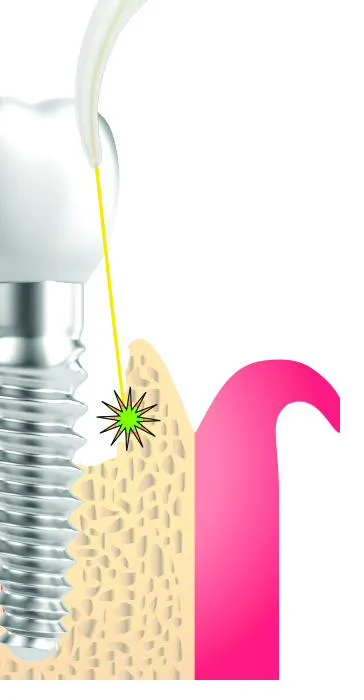 Anatomical illustration showing a dental implant in cross-section, surrounded by bone and gum tissue, with the Er:YAG laser tip directing energy at the peri-implant pocket where biofilm has accumulated