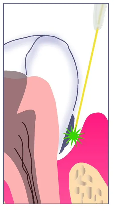 Cross-section anatomical illustration of the laser beam targeting bacterial colonies deep at the base of a periodontal pocket between the tooth and the surrounding bone