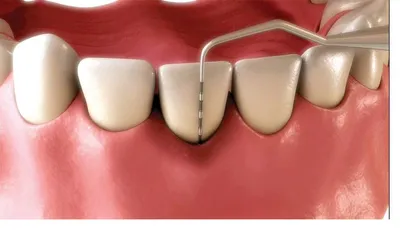 Diagram of periodontal pocket measurement around a tooth showing bacterial inflammation