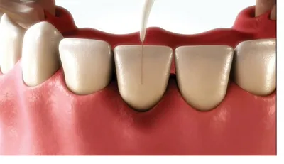 Illustration of fine laser fibre being inserted along the gum margin