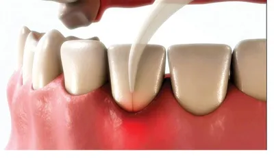 Three-dimensional rendering of a fine laser fibre tip being placed gently between the gum and a front tooth showing care with soft tissue