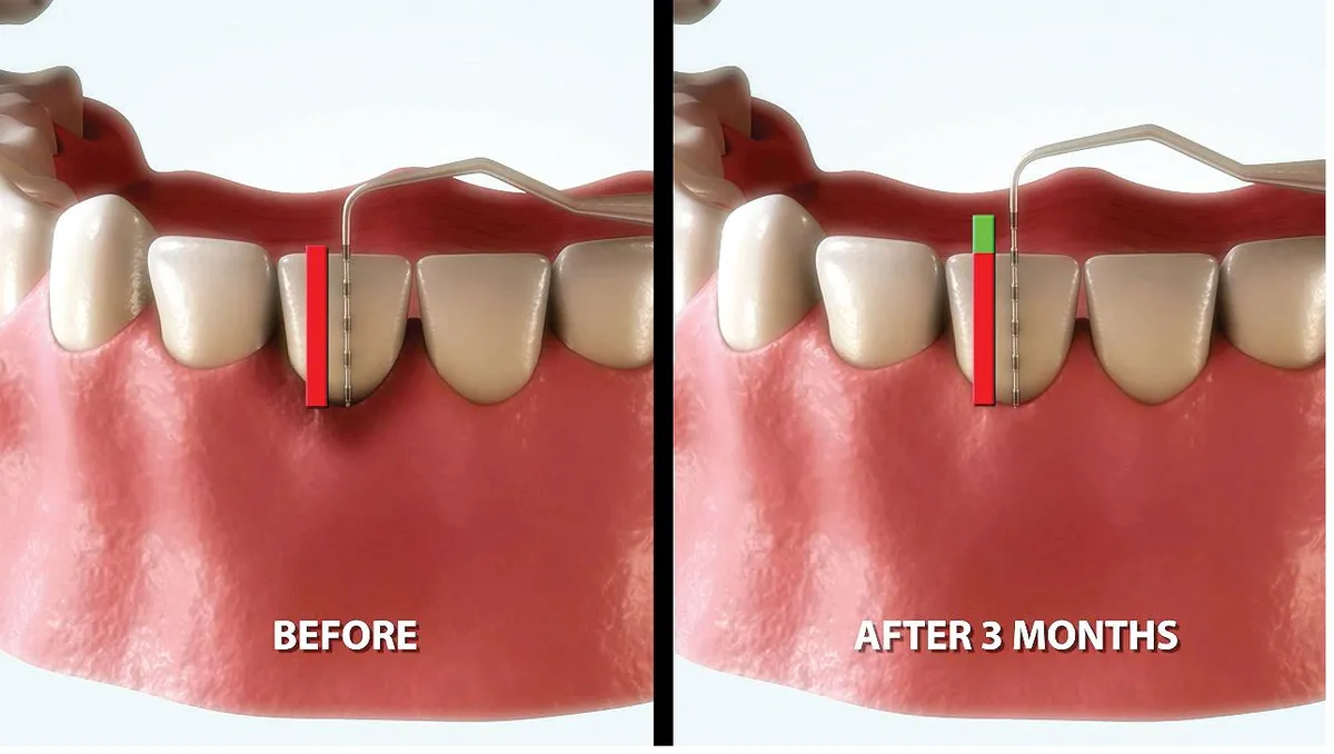 Clinical illustration showing periodontal pocket depth before treatment and after three months — for educational purposes only.