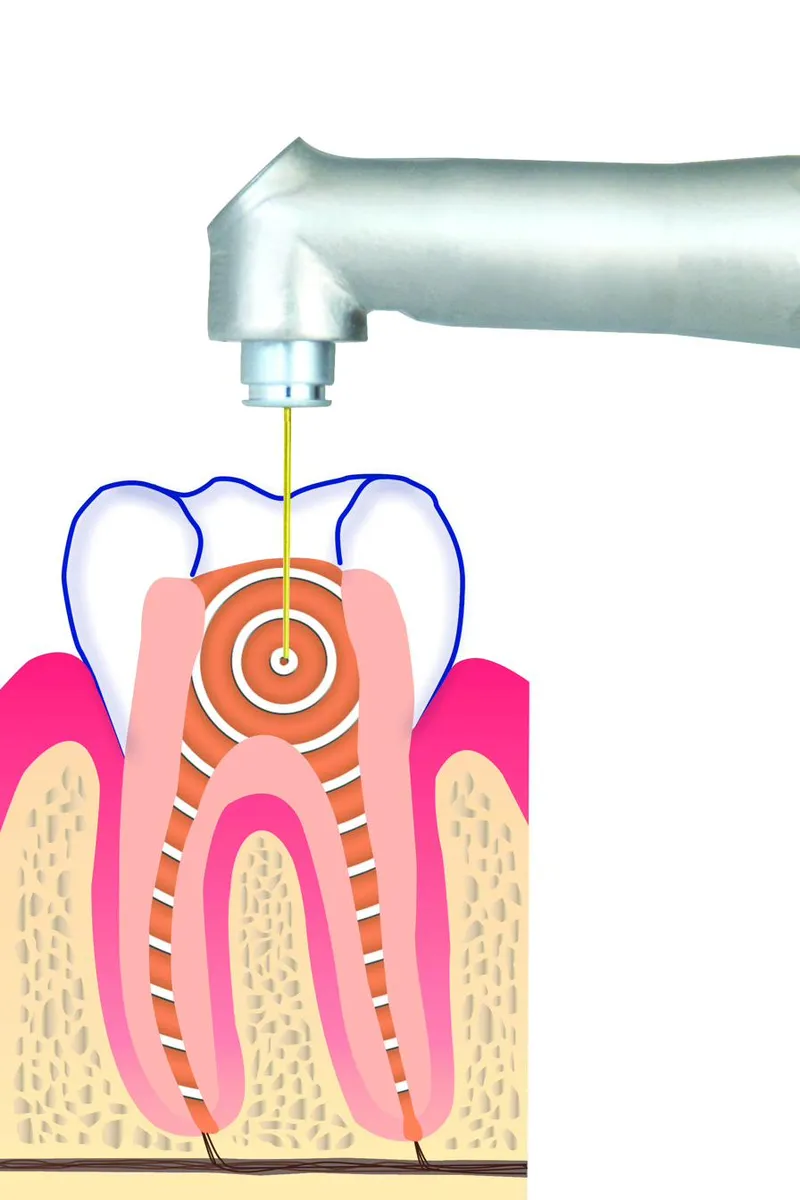 Cross-section illustration of an Er:YAG laser delivering 2940 nm energy to a tooth, showing how the wavelength interacts with hydrated tissue.