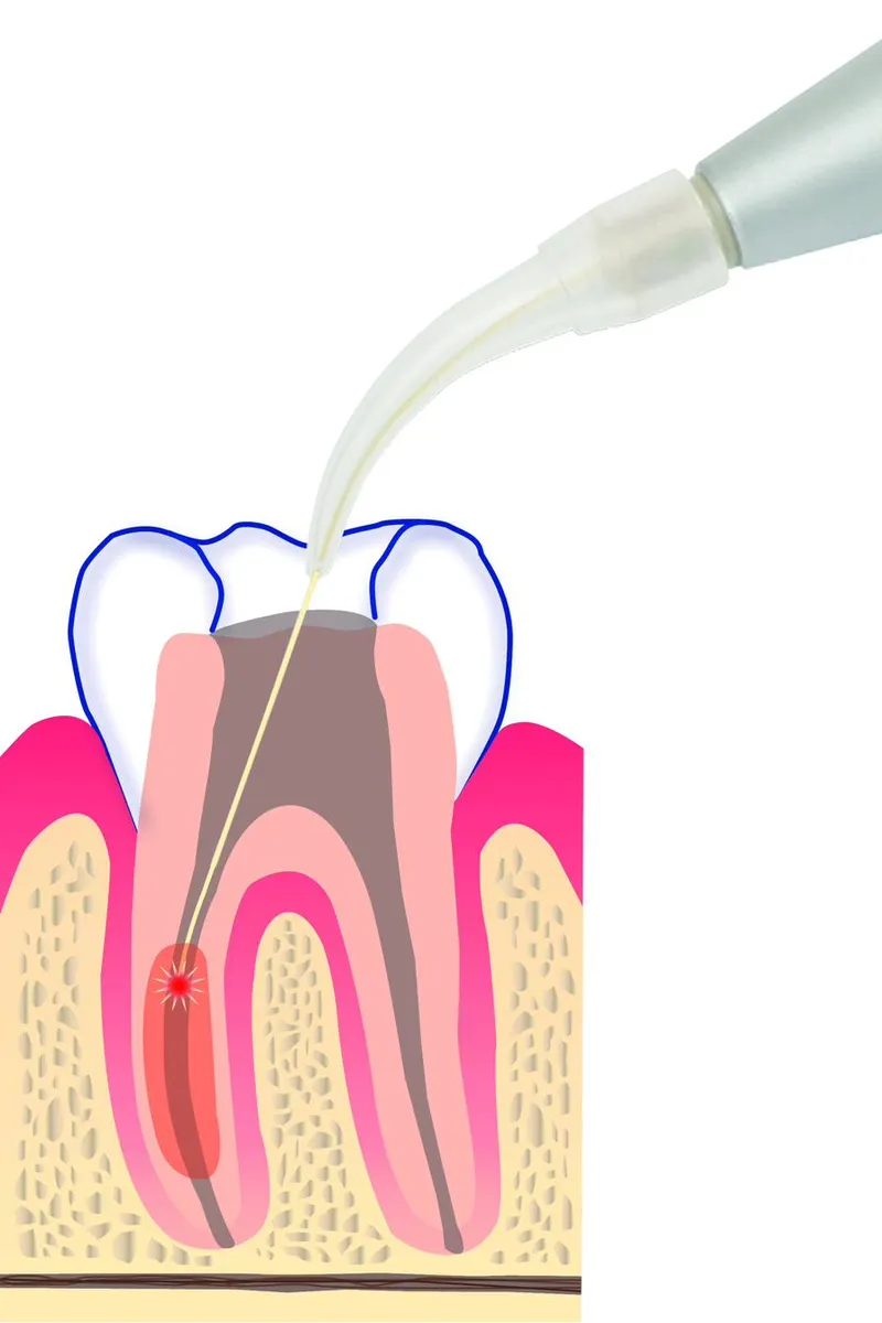 Cross-section illustration of an Nd:YAG laser fibre delivering 1064 nm energy beneath the gumline into a periodontal pocket.