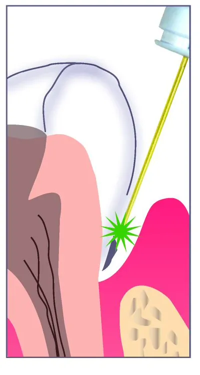 Illustration of the first TwinLight pass — Nd:YAG laser energy delivered into a periodontal pocket to address pigmented bacteria and inflamed tissue.