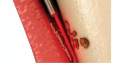 Illustration of the second TwinLight pass — Er:YAG laser energy used to remove calculus and prepare the root surface inside the periodontal pocket.