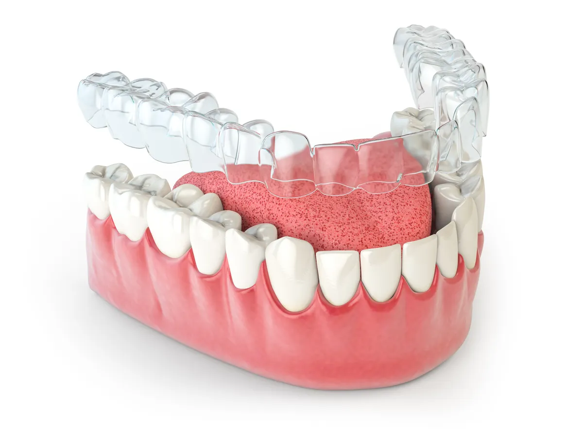 A model showing a clear Invisalign-style aligner tray fitted over the lower teeth