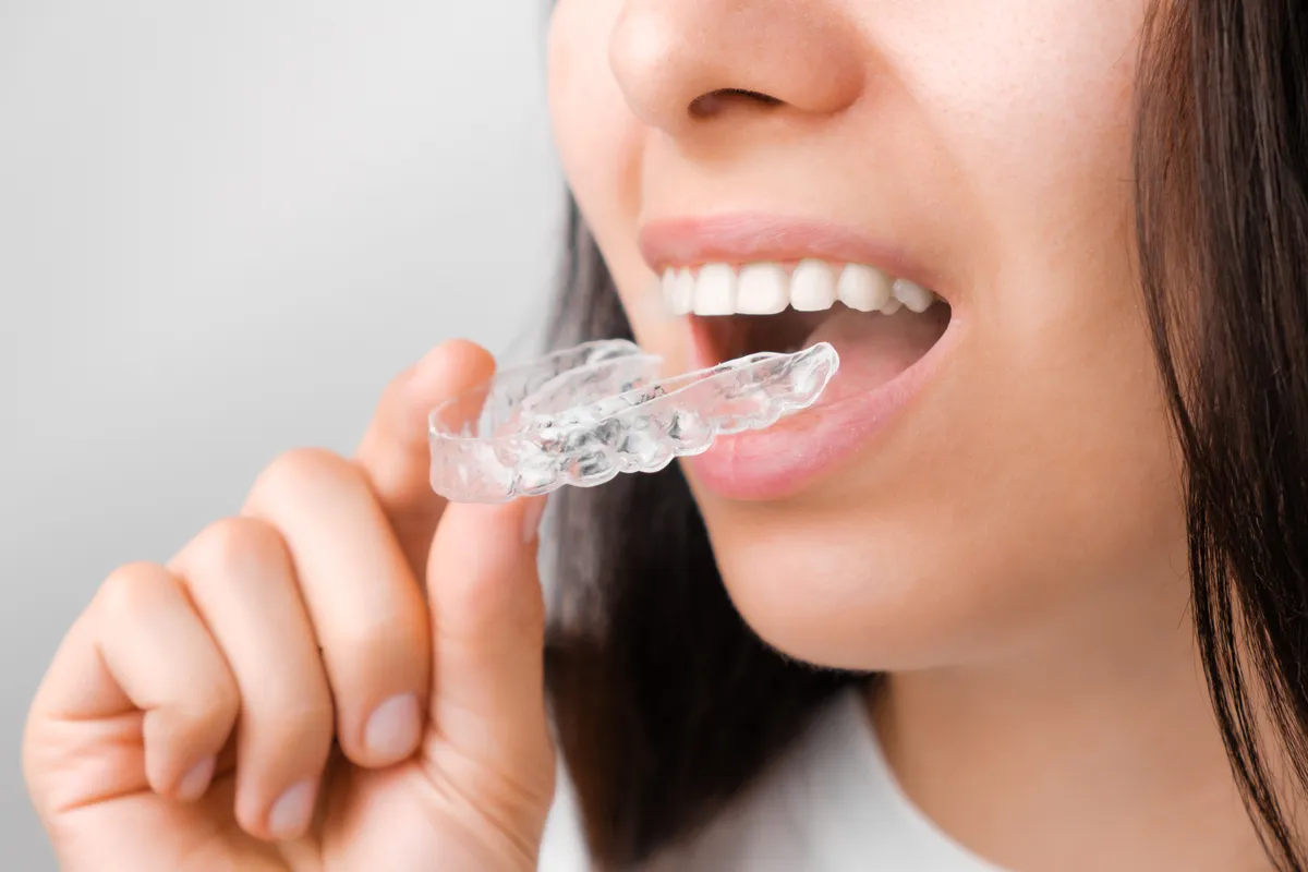 A young woman fitting a clear aligner tray over her teeth