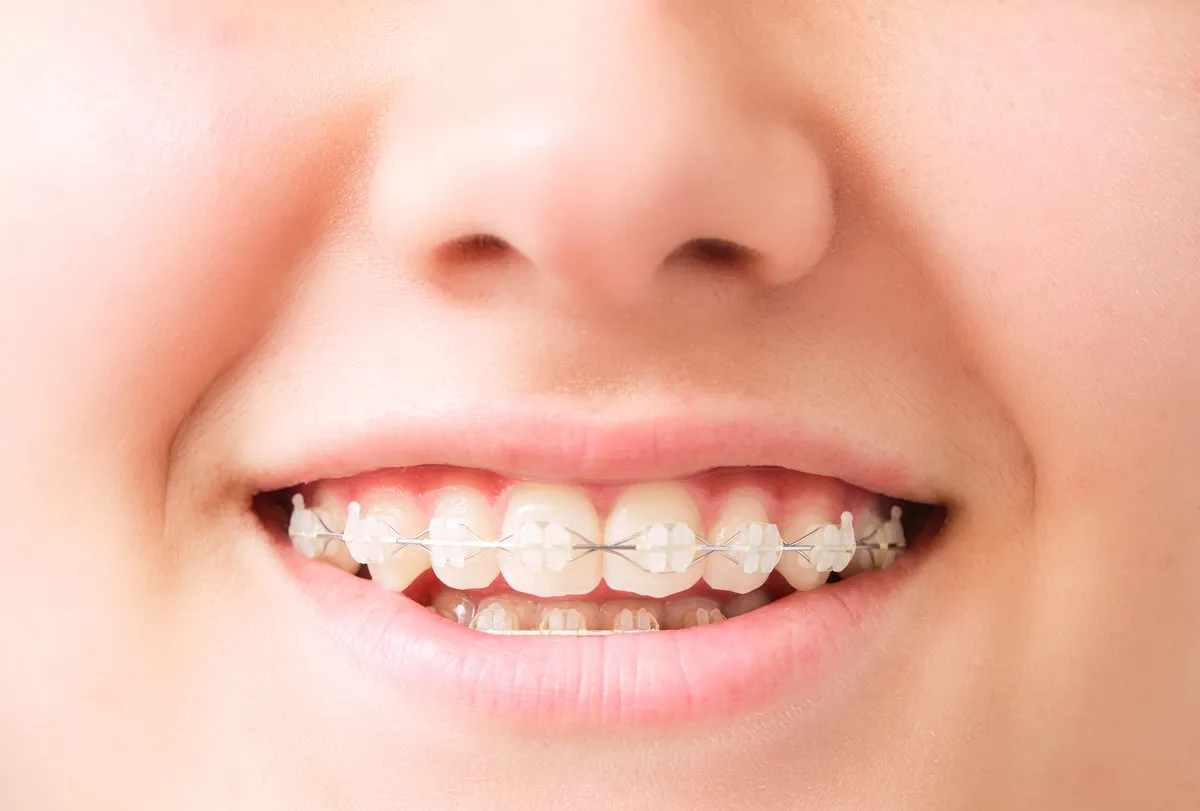 Close-up of clear ceramic braces brackets on teeth