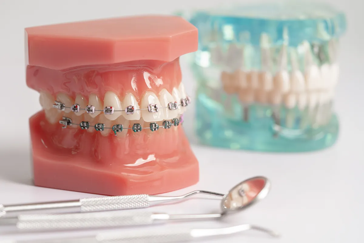 Orthodontic tools beside a teeth model illustrating orthodontic planning